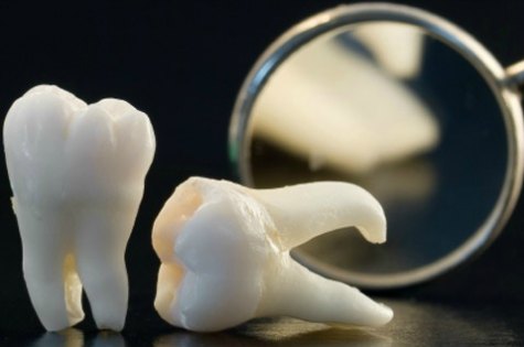 dental-implants-image-1.jpg