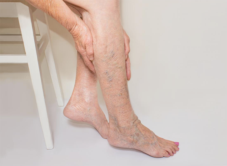 prevent-varicose-veins